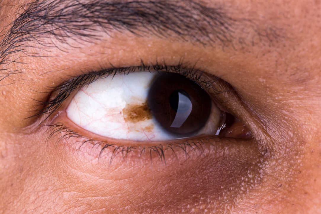 ocular-melanoma-treatment-zacslegacyfoundation