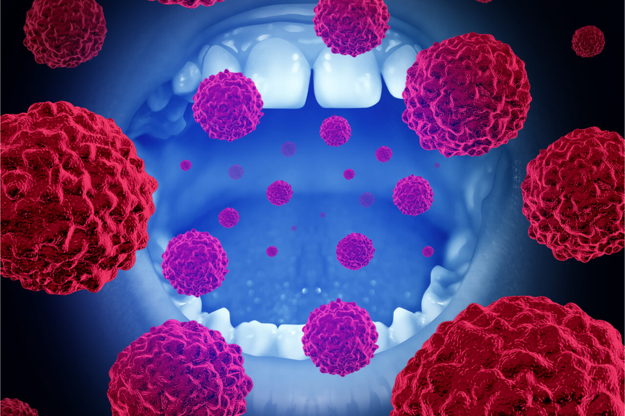 What Do The Early Stages Of Mouth Cancer Look Like