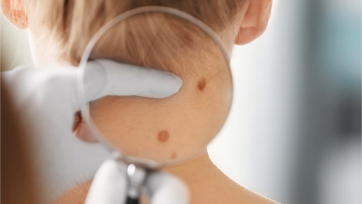 Skin Cancer In Children: How To Identify It?