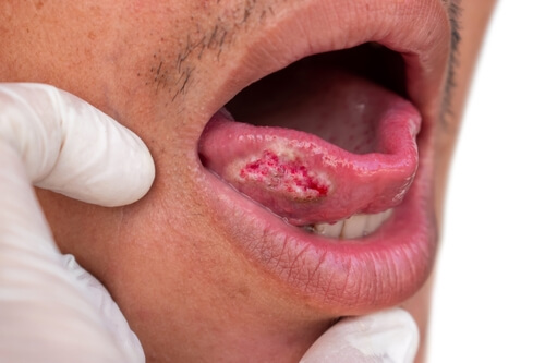 Signs Of Oral Cancer Tongue Zacs Legacy Foundation