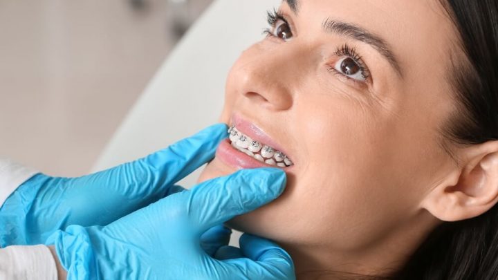 Root Resorption Braces: Unveiling the Connection