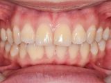 oral cancer on gums